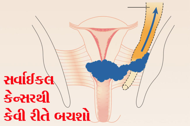 સર્વાઈકલ કેન્સરથી કેવી રીતે બચશો