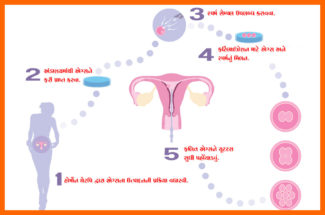 આઈવીએફ આ પણ જાણો